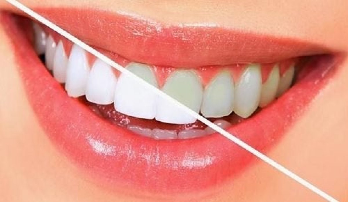 Gülüşünüzle fark yaratın! İşte dişlerinizi beyazlatacak 5 süper yiyecek! #1