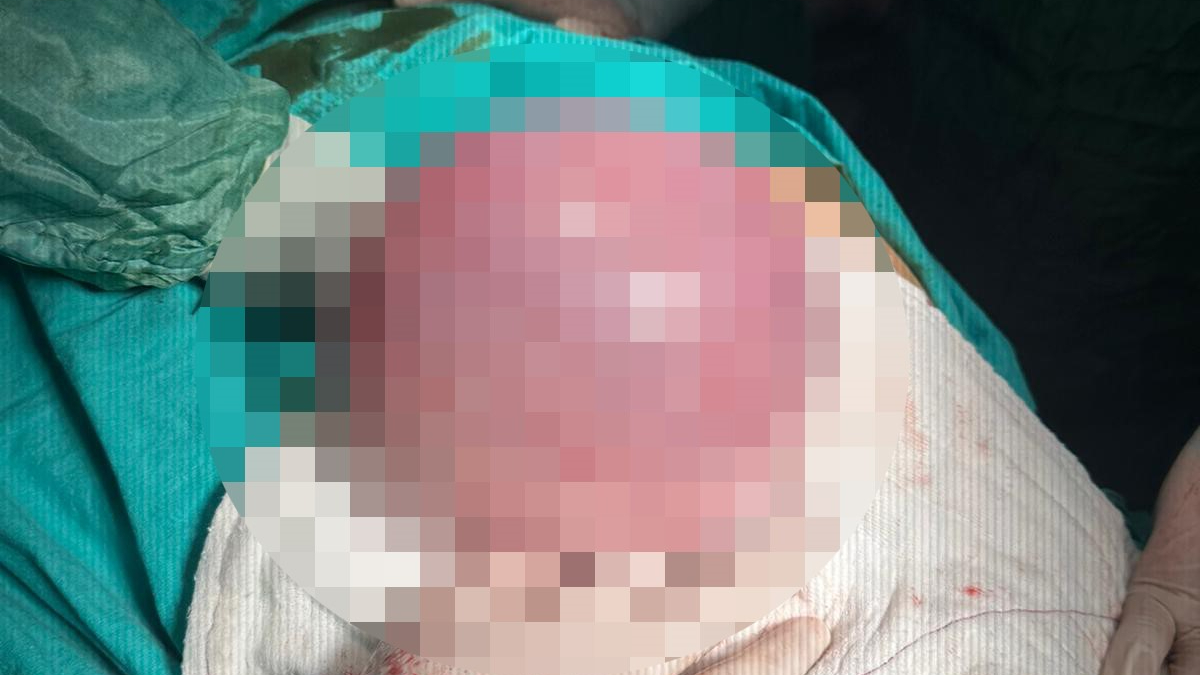 Batman'daki hasta, karnındaki dev tümörden kurtuldu