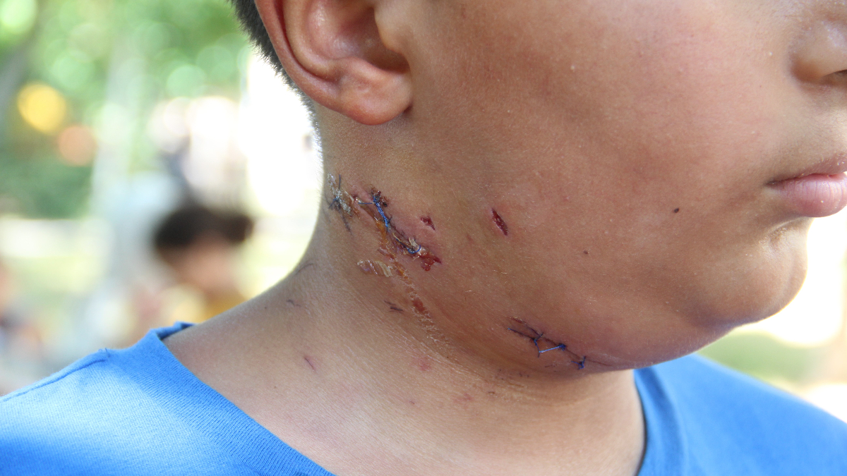 Antalya'da küçük çocuk köpek saldırısına uğradı! Boynuna 6 dikiş atıldı