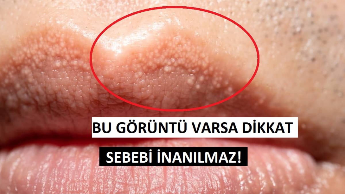 Dudaktaki minik beyaz noktaların gizemi çözüldü!