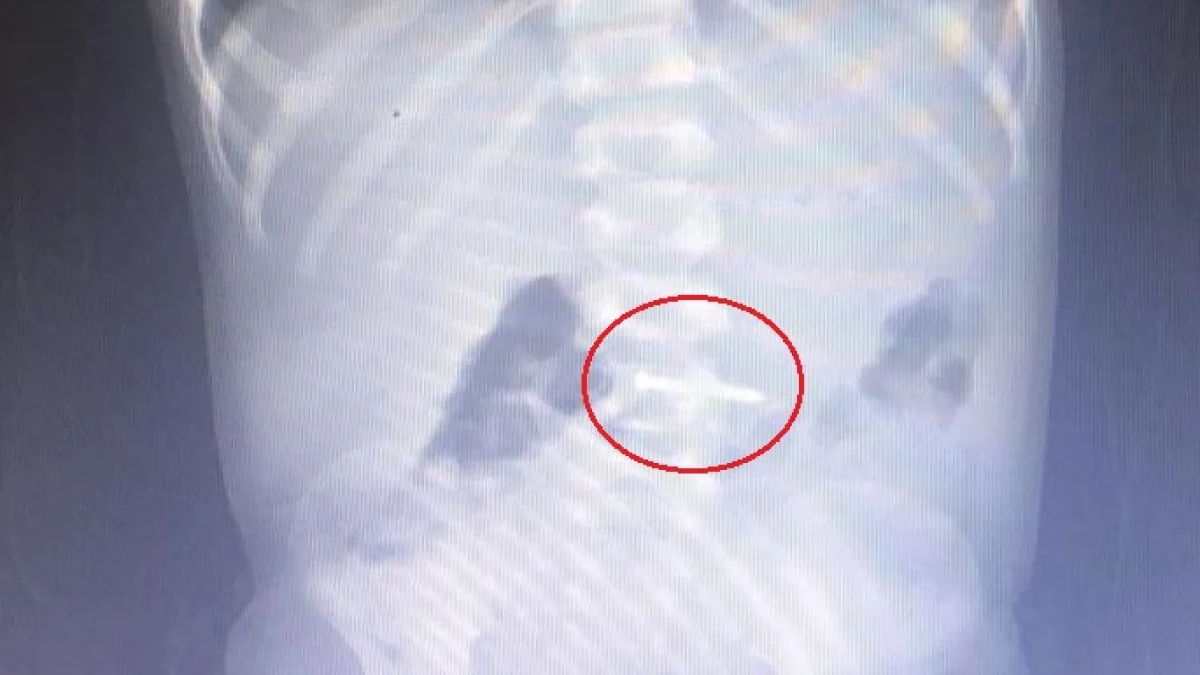 Bursa'da oyun oynayan 2 yaşındaki çocuk çivi yuttu