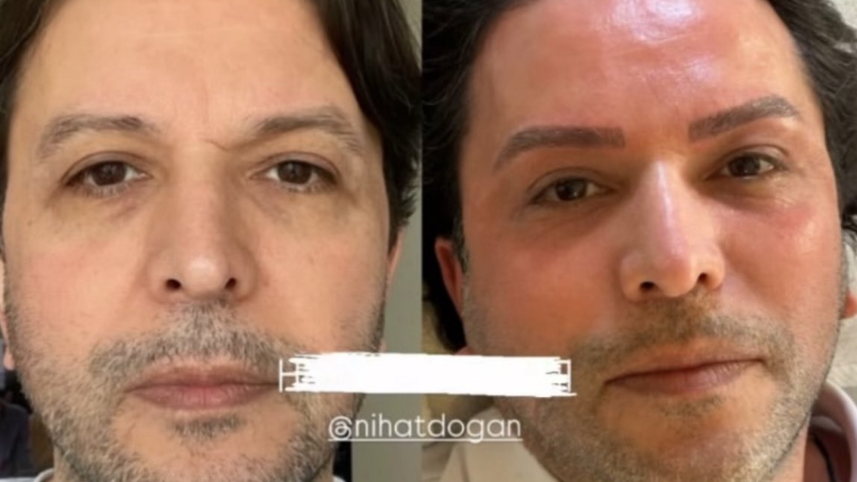 Nihat Doğan estetik işlem yaptırdı Nihat Doğan estetik işlem yaptırdı