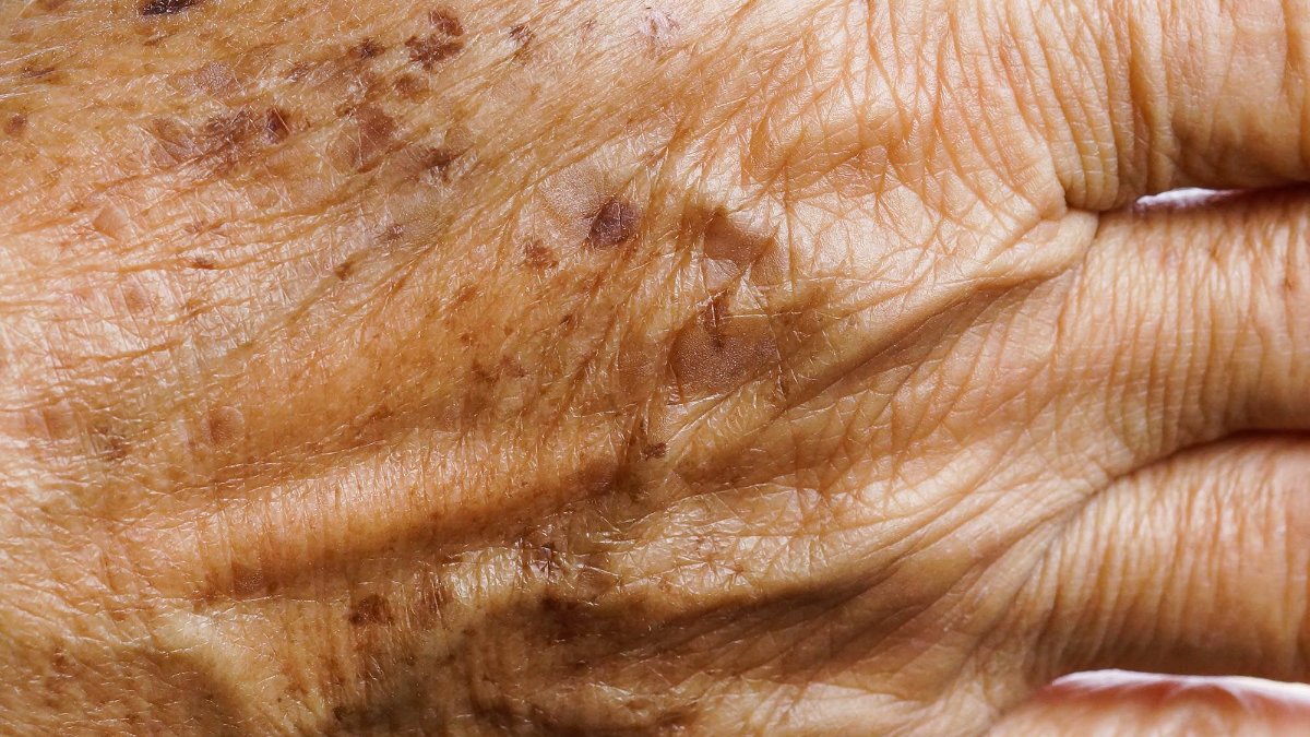 Günde 1 kez sürün, yaşlılık lekelerini götürün...