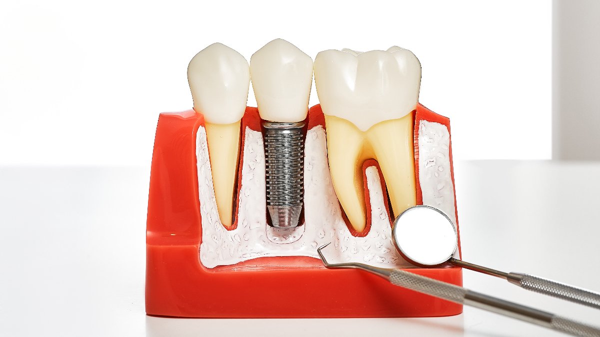 Diş tedavisinde yeni dönem: İmplant SSK kapsamına giriyor