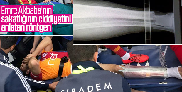 Emre Akbaba'nın ayağında 2 kırık var