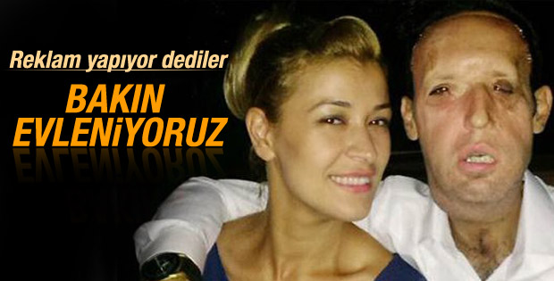 Yüz nakli yapılan Recep Sert evleniyor