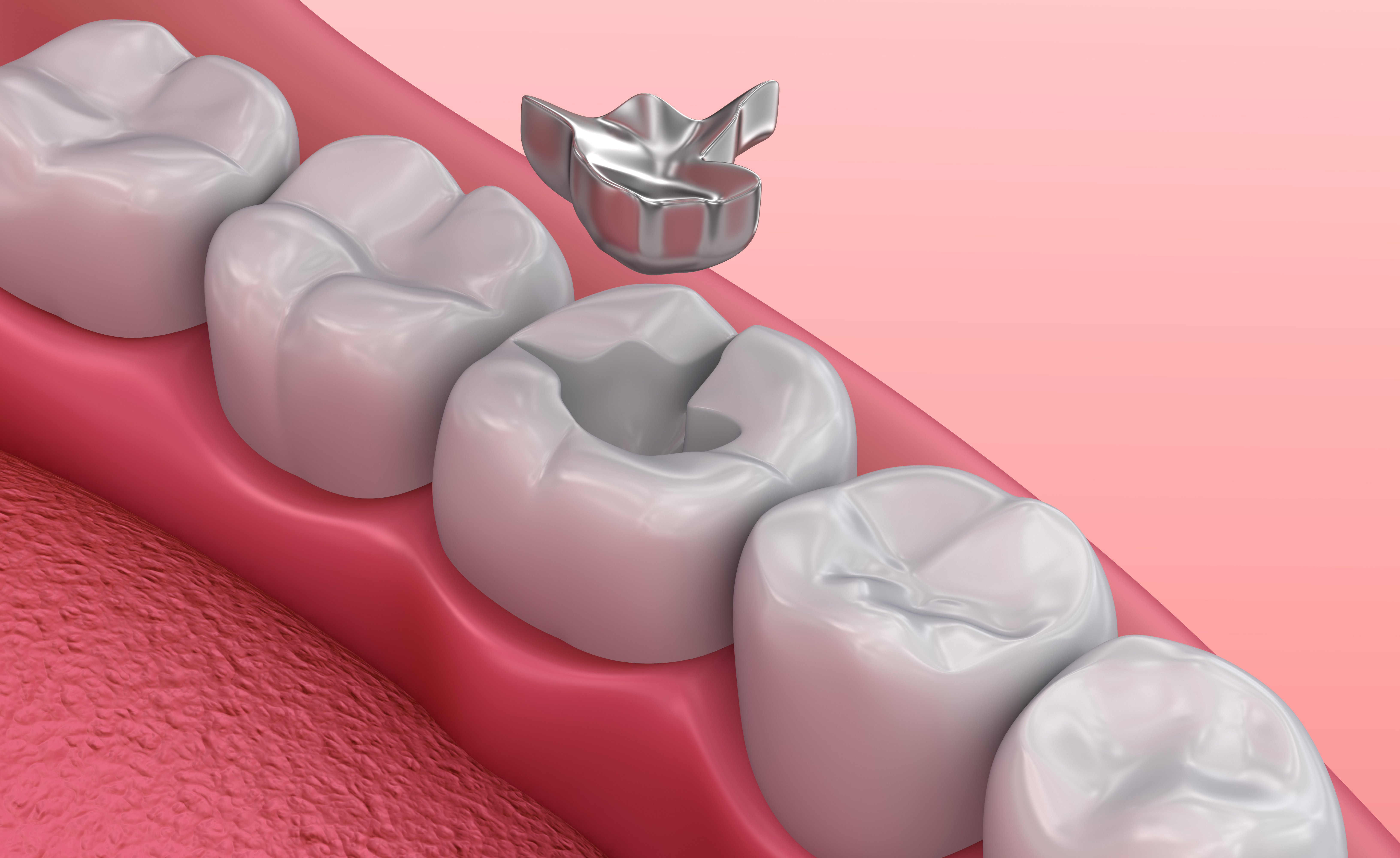 The most reliable method in dental treatment: Silver Filling #2