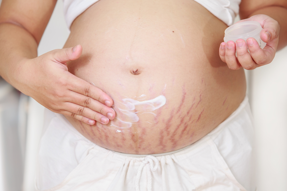 6 ways to make your stretch marks less visible #1