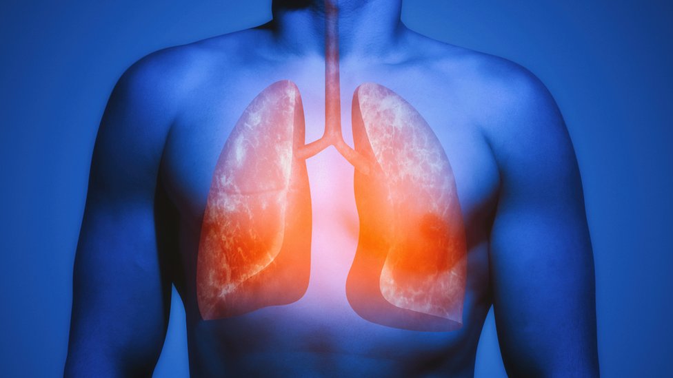 Akciğerlerde sertleşme solunum yetmezliğine neden olabilir #1
