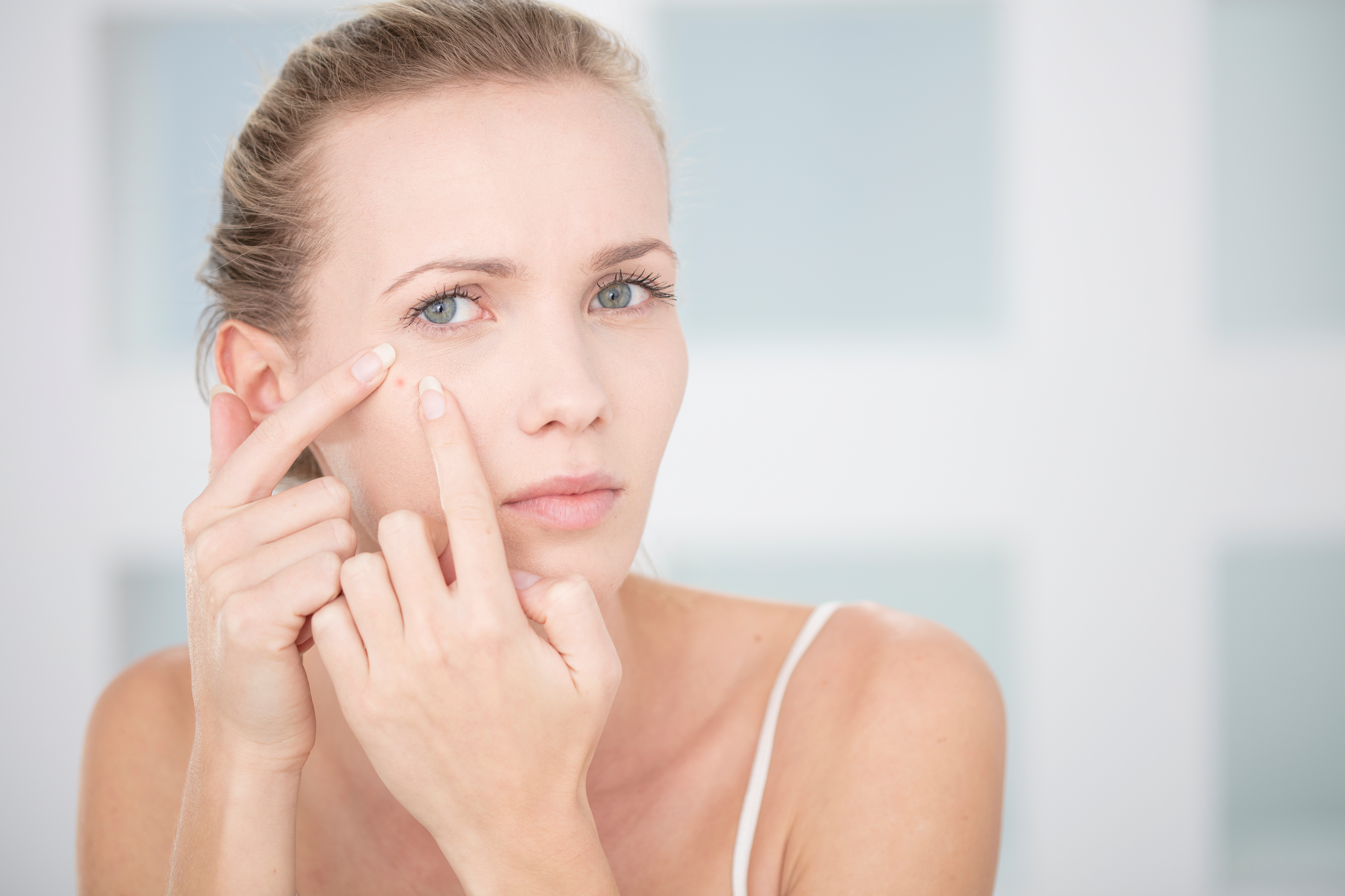 Some individuals may be predisposed to the development of acne #1