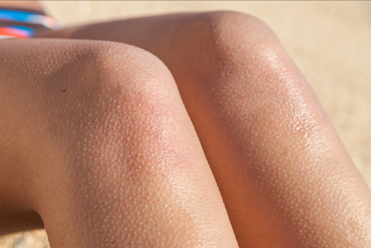 6 reasons that trigger the appearance of chicken skin on your skin #1