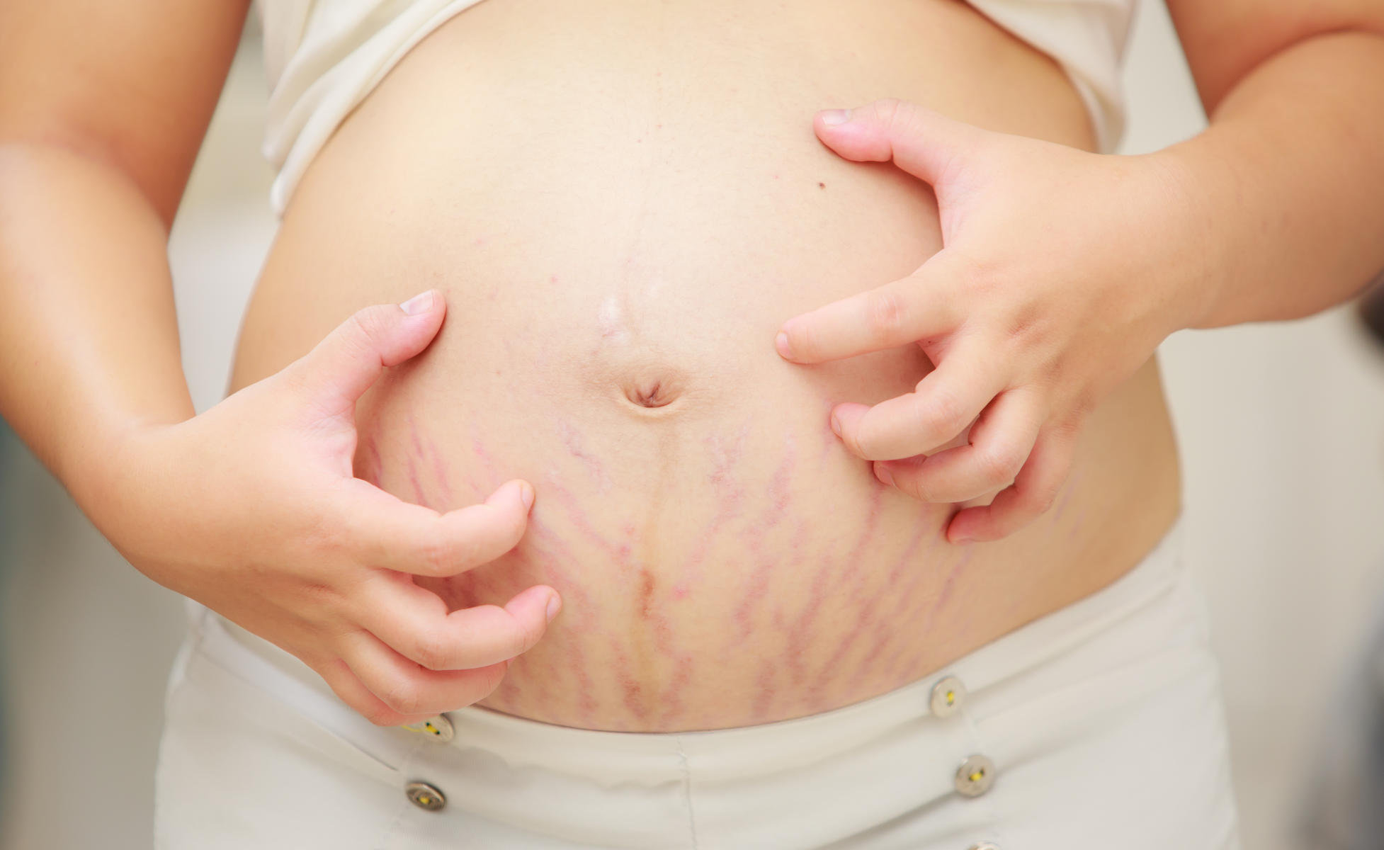 The 4 most visible skin changes during pregnancy #2