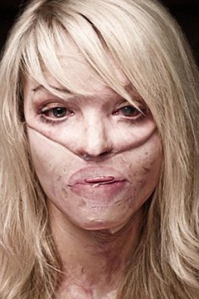 Kezzap kurbanı manken 110 ameliyat sonrası spiker oldu 