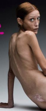 Isabelle Caro anoreksiyadan öldü