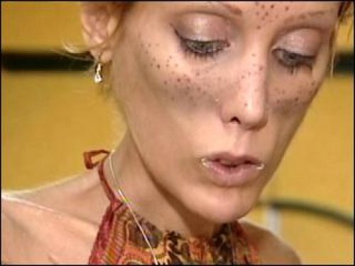 Isabelle Caro anoreksiyadan öldü
