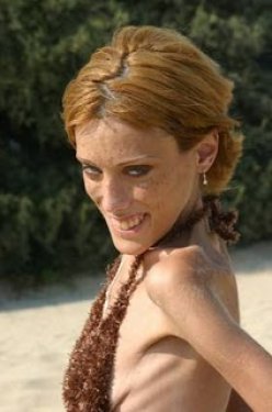 Isabelle Caro anoreksiyadan öldü