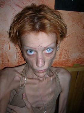 Isabelle Caro anoreksiyadan öldü