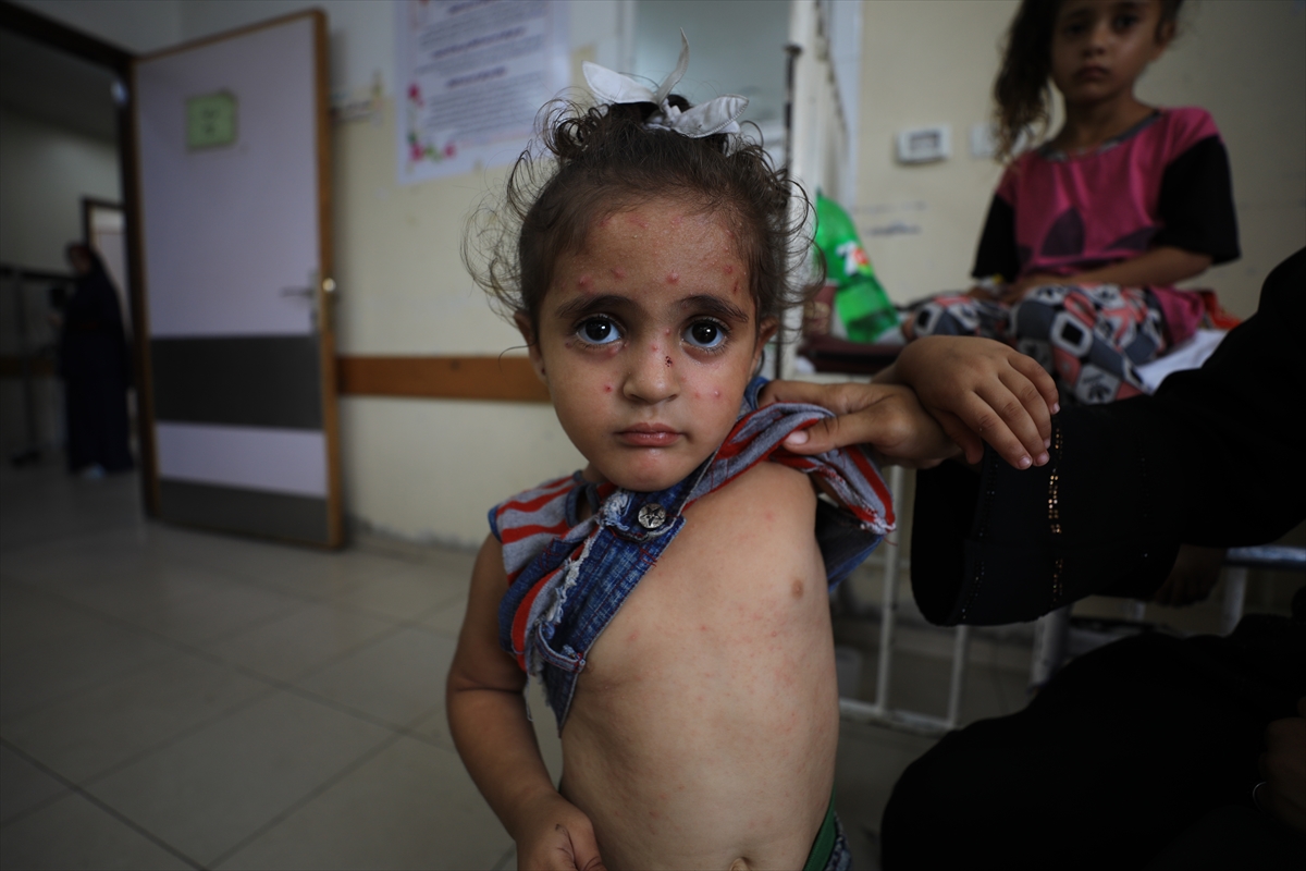Gazze'de hijyen krizi: Çocuklarda cilt hastalıkları başladı