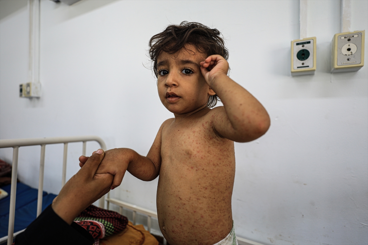 Gazze'de hijyen krizi: Çocuklarda cilt hastalıkları başladı