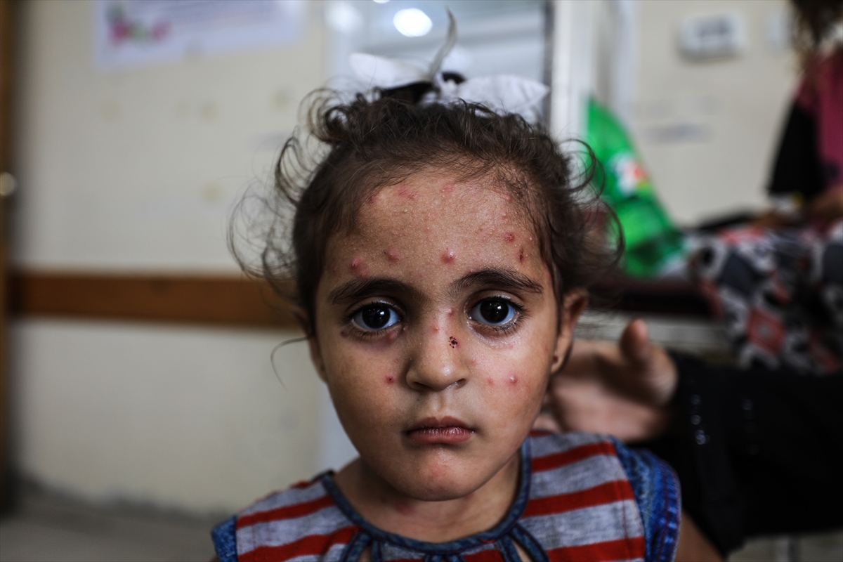 Gazze'de hijyen krizi: Çocuklarda cilt hastalıkları başladı