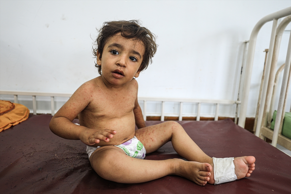 Gazze'de hijyen krizi: Çocuklarda cilt hastalıkları başladı