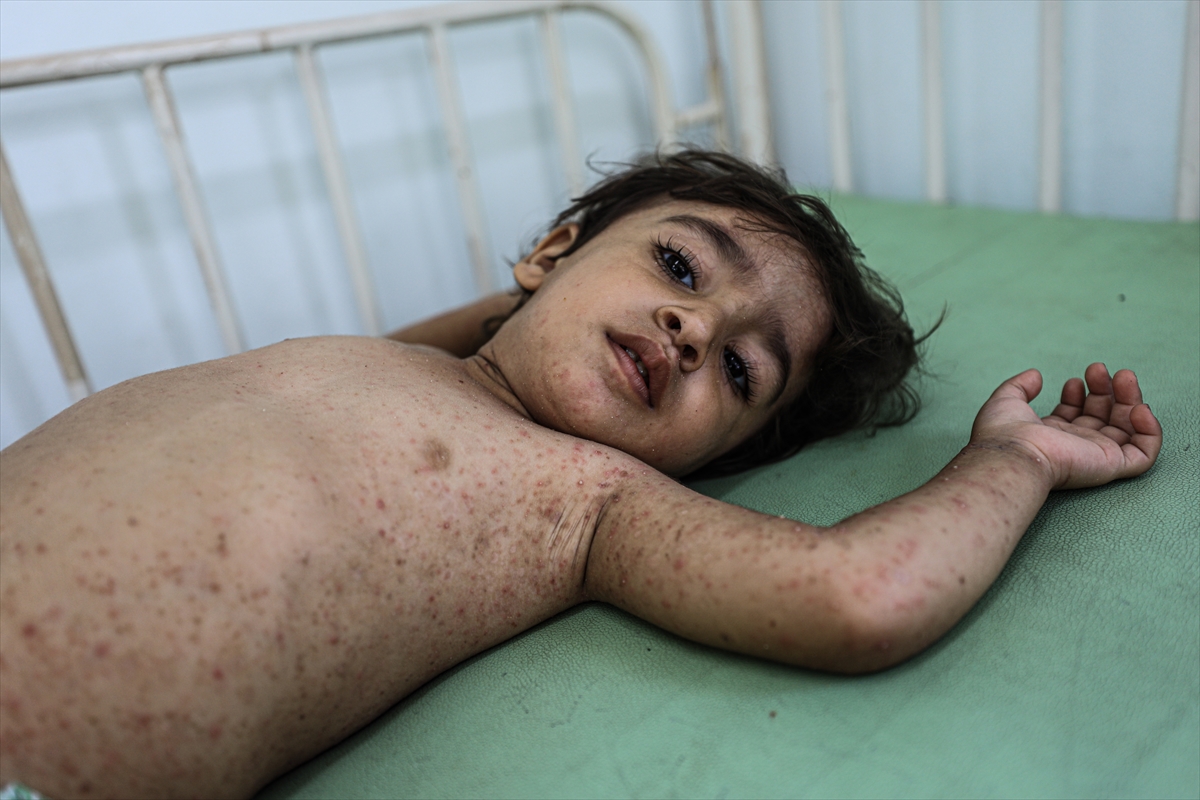 Gazze'de hijyen krizi: Çocuklarda cilt hastalıkları başladı