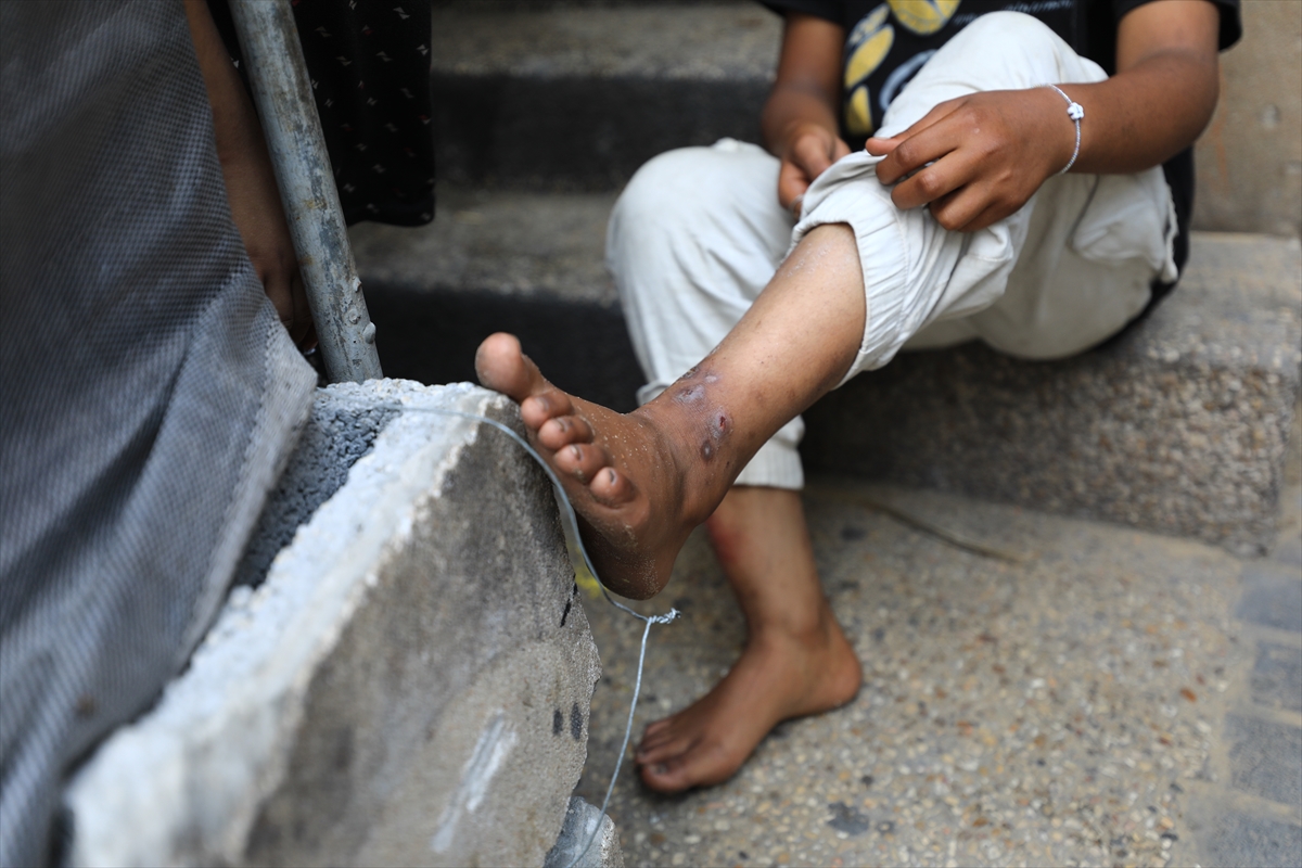 Gazze'de hijyen krizi: Çocuklarda cilt hastalıkları başladı