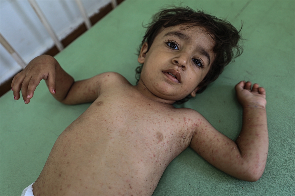 Gazze'de hijyen krizi: Çocuklarda cilt hastalıkları başladı