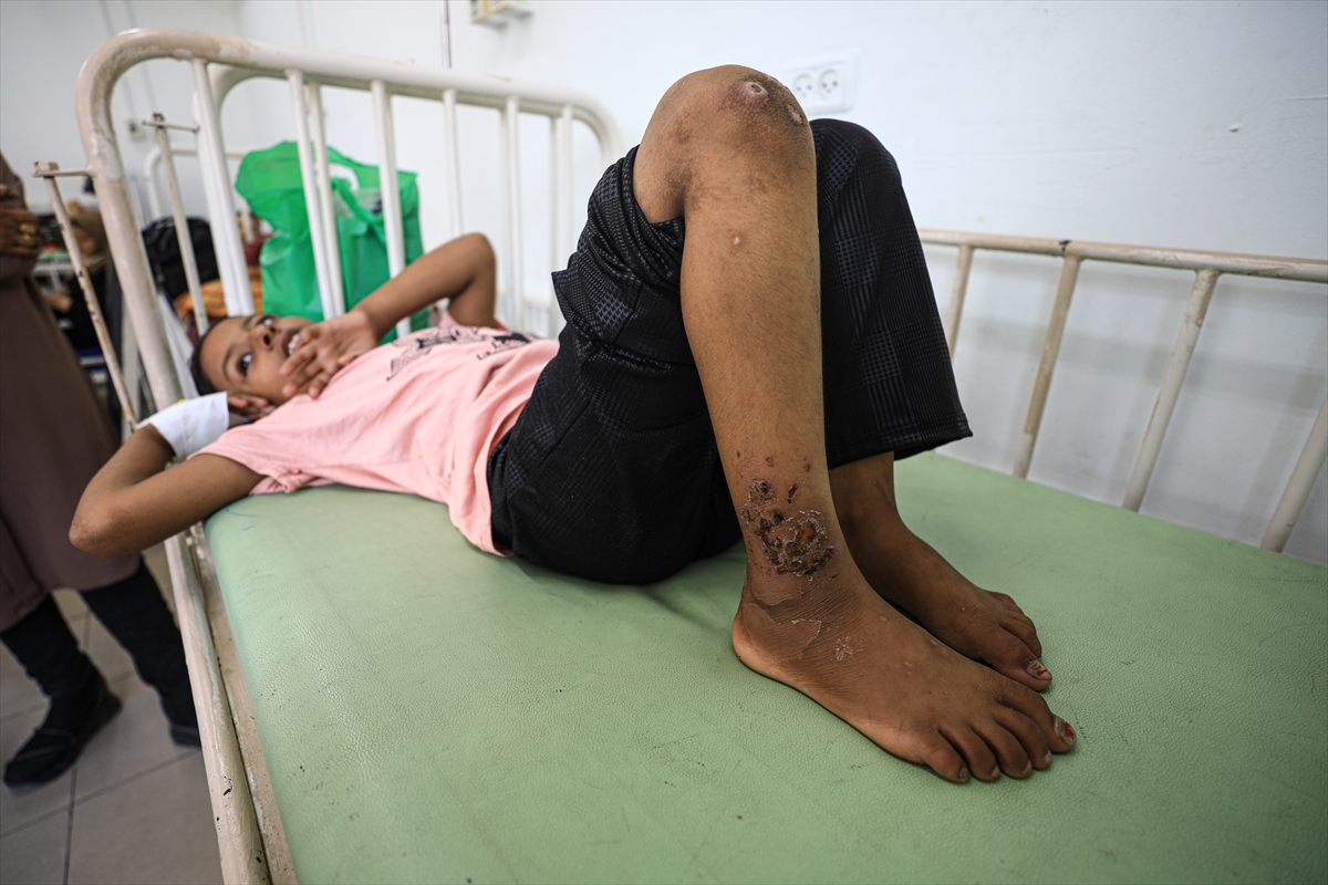 Gazze'de hijyen krizi: Çocuklarda cilt hastalıkları başladı