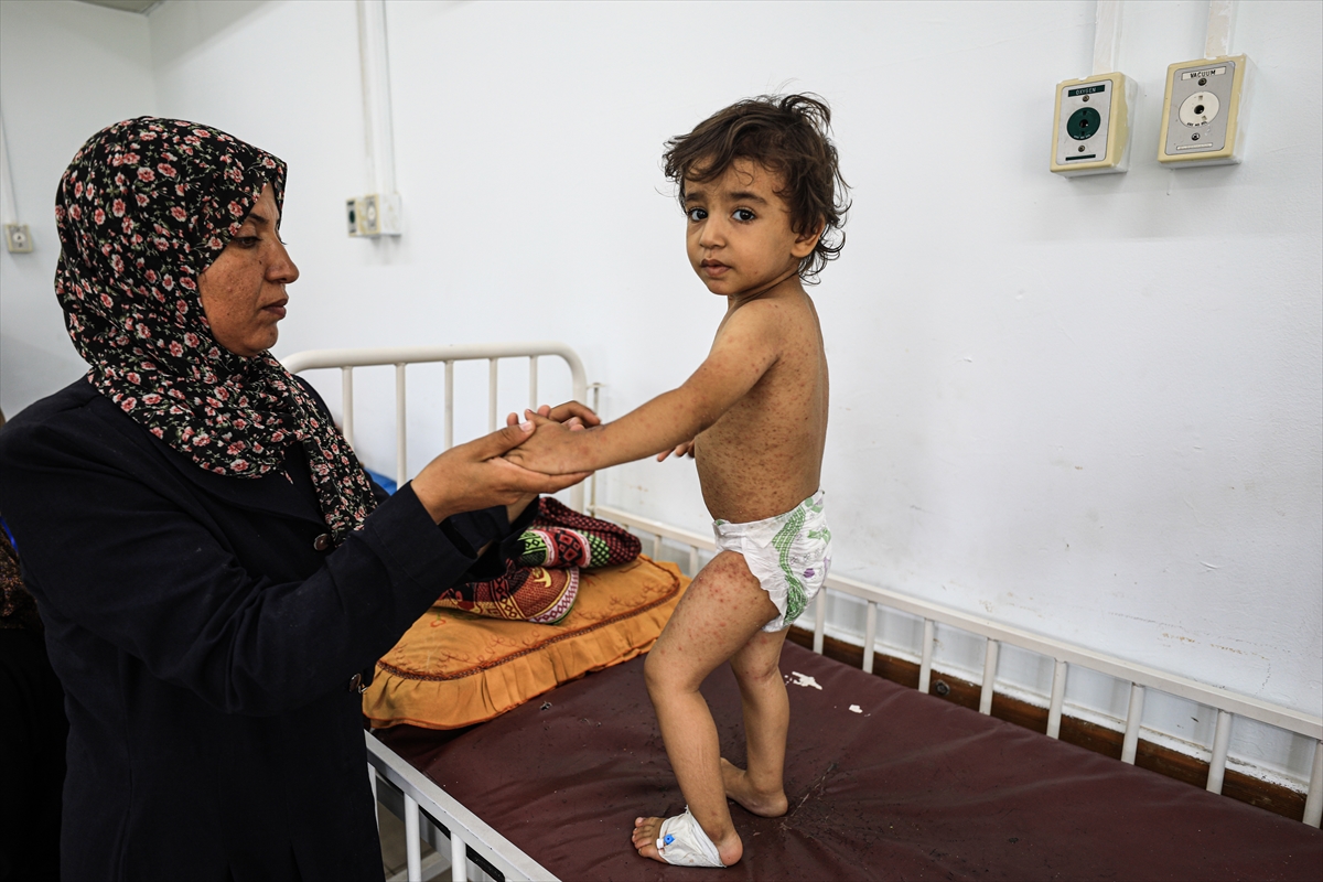 Gazze'de hijyen krizi: Çocuklarda cilt hastalıkları başladı