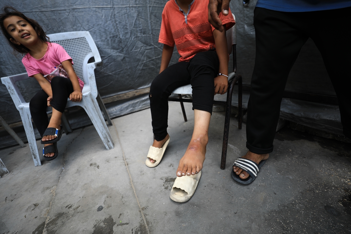 Gazze'de hijyen krizi: Çocuklarda cilt hastalıkları başladı