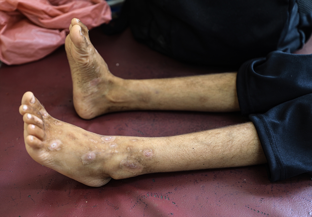 Gazze'de hijyen krizi: Çocuklarda cilt hastalıkları başladı