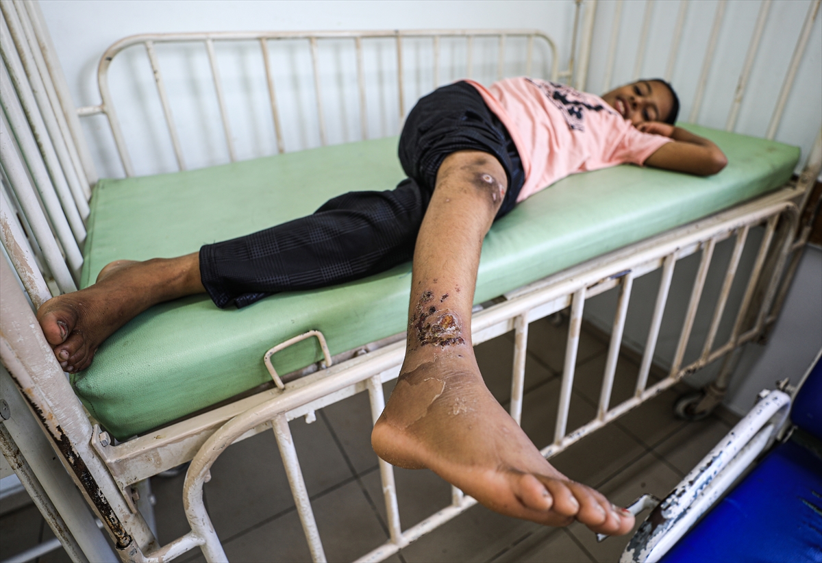 Gazze'de hijyen krizi: Çocuklarda cilt hastalıkları başladı