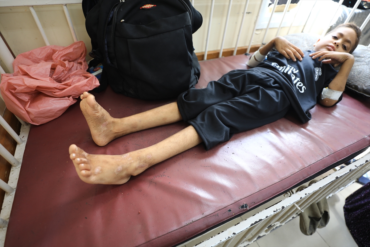 Gazze'de hijyen krizi: Çocuklarda cilt hastalıkları başladı