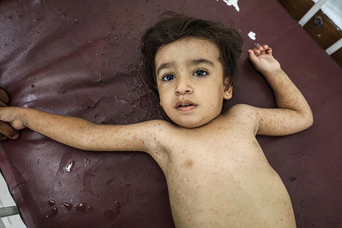 Gazze'de hijyen krizi: Çocuklarda cilt hastalıkları başladı