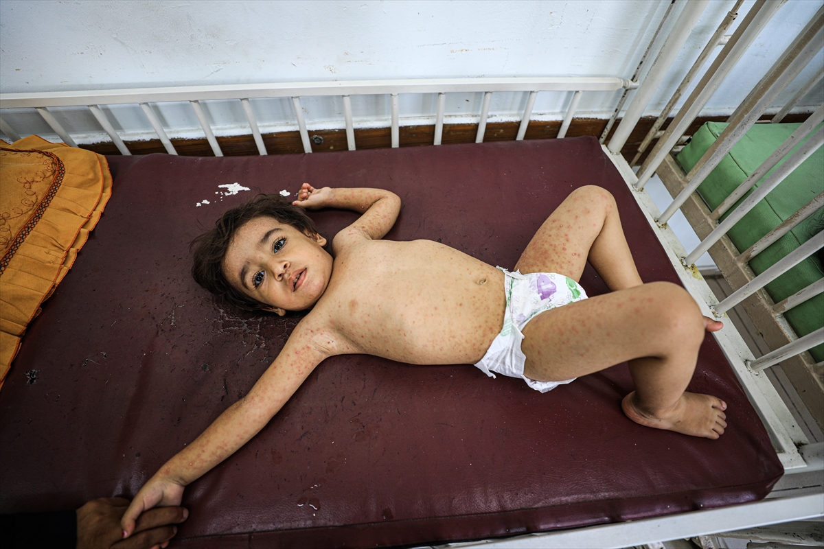 Gazze'de hijyen krizi: Çocuklarda cilt hastalıkları başladı