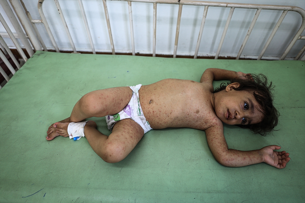 Gazze'de hijyen krizi: Çocuklarda cilt hastalıkları başladı