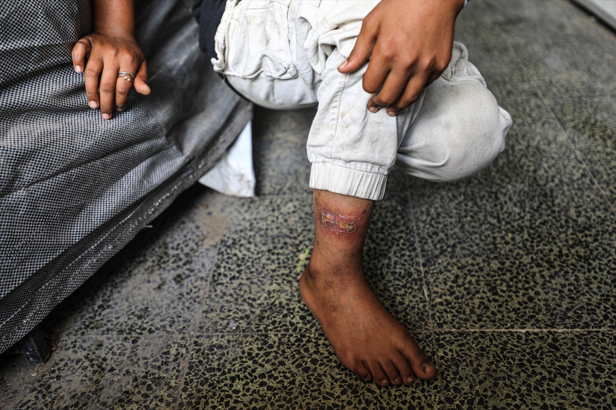 Gazze'de hijyen krizi: Çocuklarda cilt hastalıkları başladı