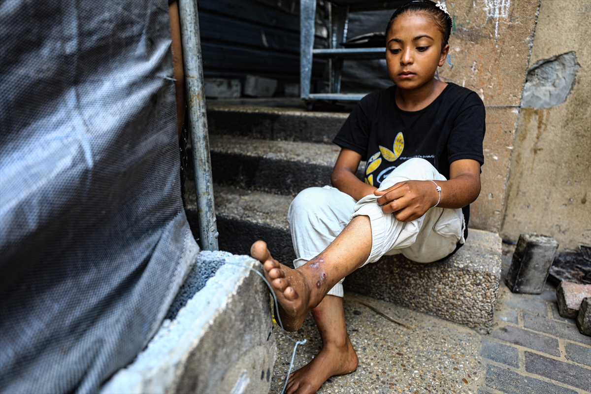 Gazze'de hijyen krizi: Çocuklarda cilt hastalıkları başladı