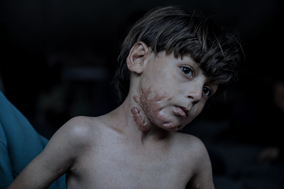 İsrail saldırısının hedefi olan çocuklardan biri: Muhammed