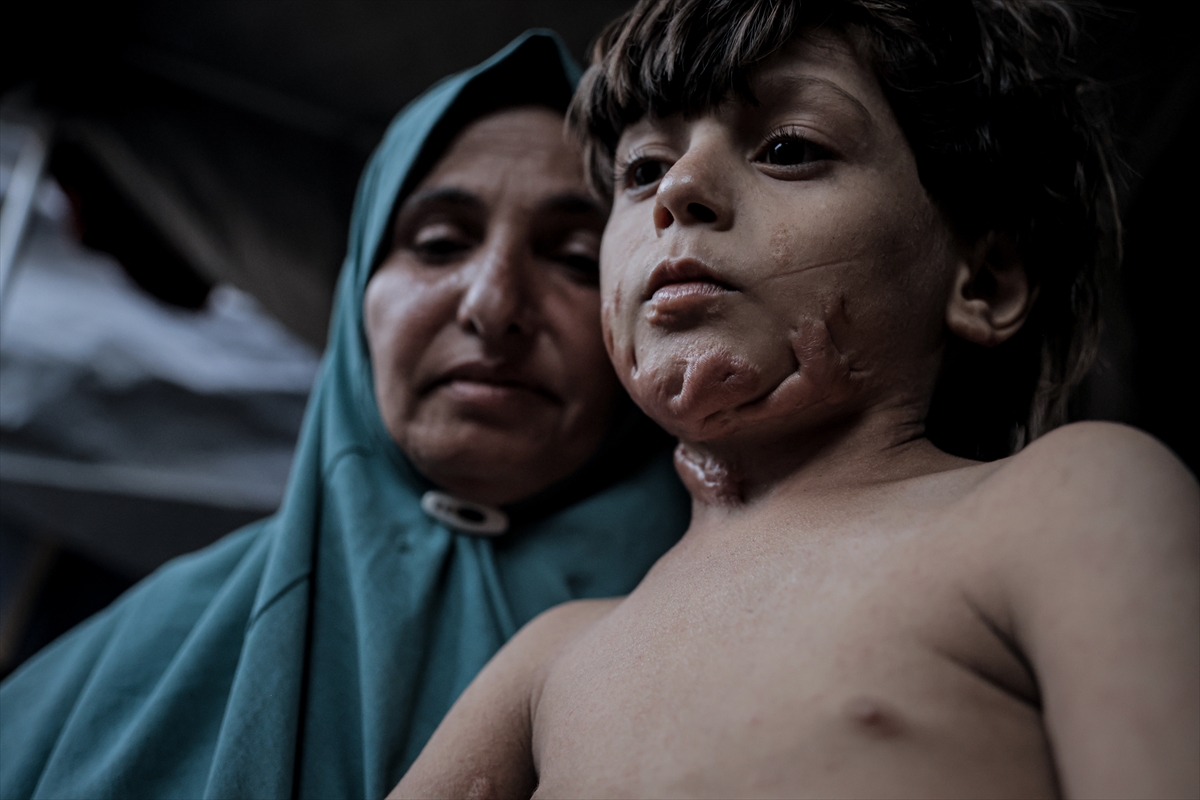 İsrail saldırısının hedefi olan çocuklardan biri: Muhammed