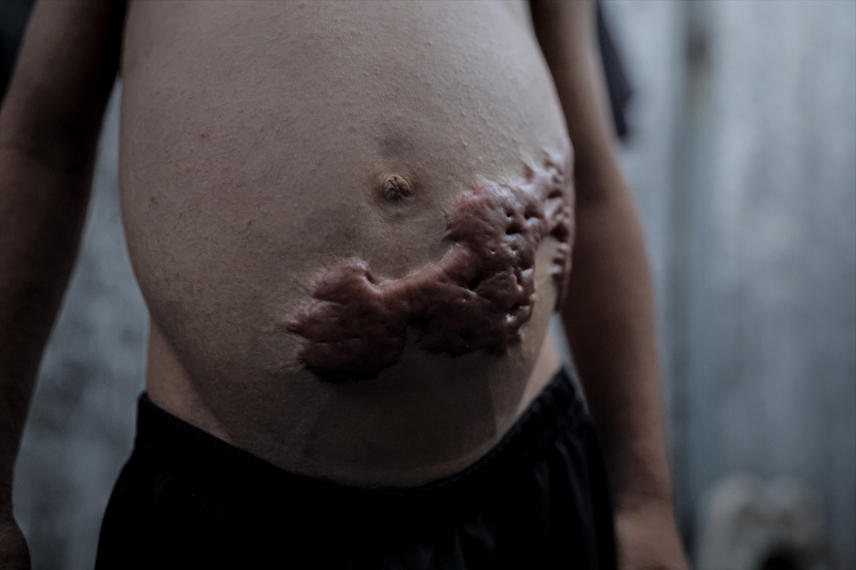 İsrail saldırısının hedefi olan çocuklardan biri: Muhammed