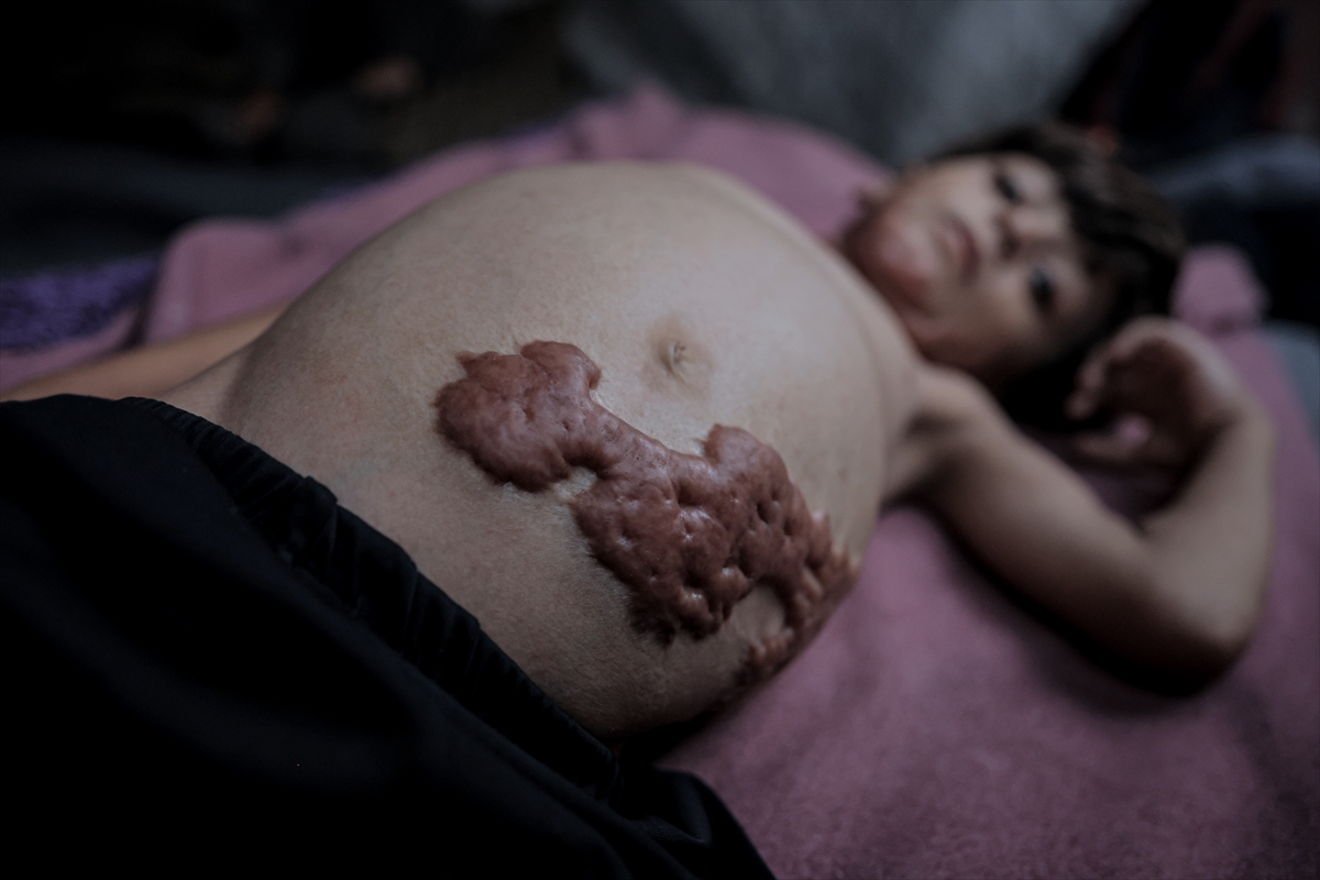 İsrail saldırısının hedefi olan çocuklardan biri: Muhammed