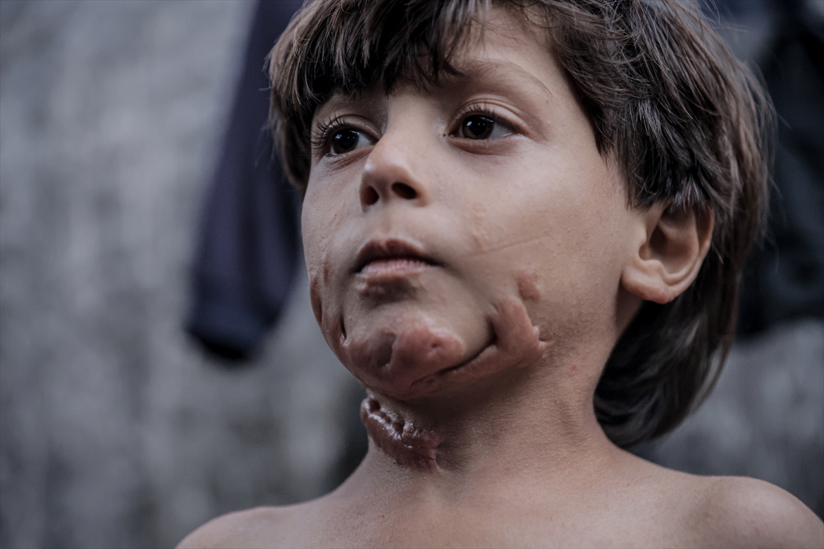 İsrail saldırısının hedefi olan çocuklardan biri: Muhammed