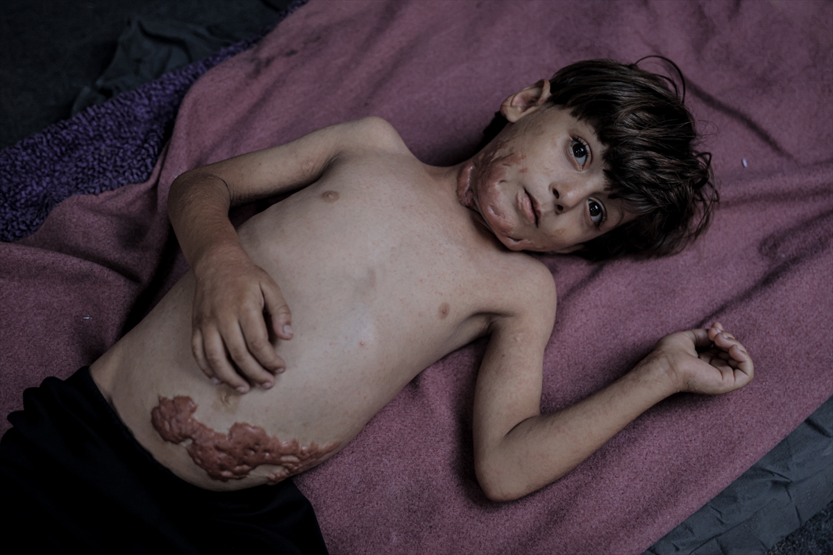 İsrail saldırısının hedefi olan çocuklardan biri: Muhammed