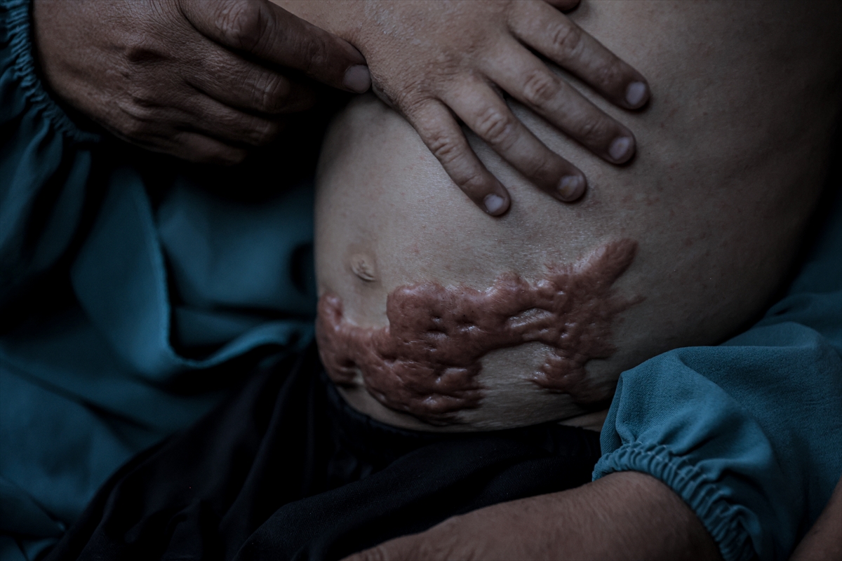 İsrail saldırısının hedefi olan çocuklardan biri: Muhammed