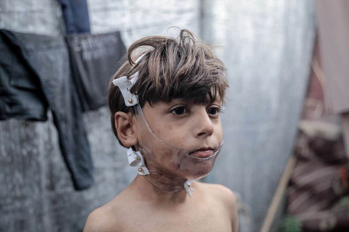 İsrail saldırısının hedefi olan çocuklardan biri: Muhammed