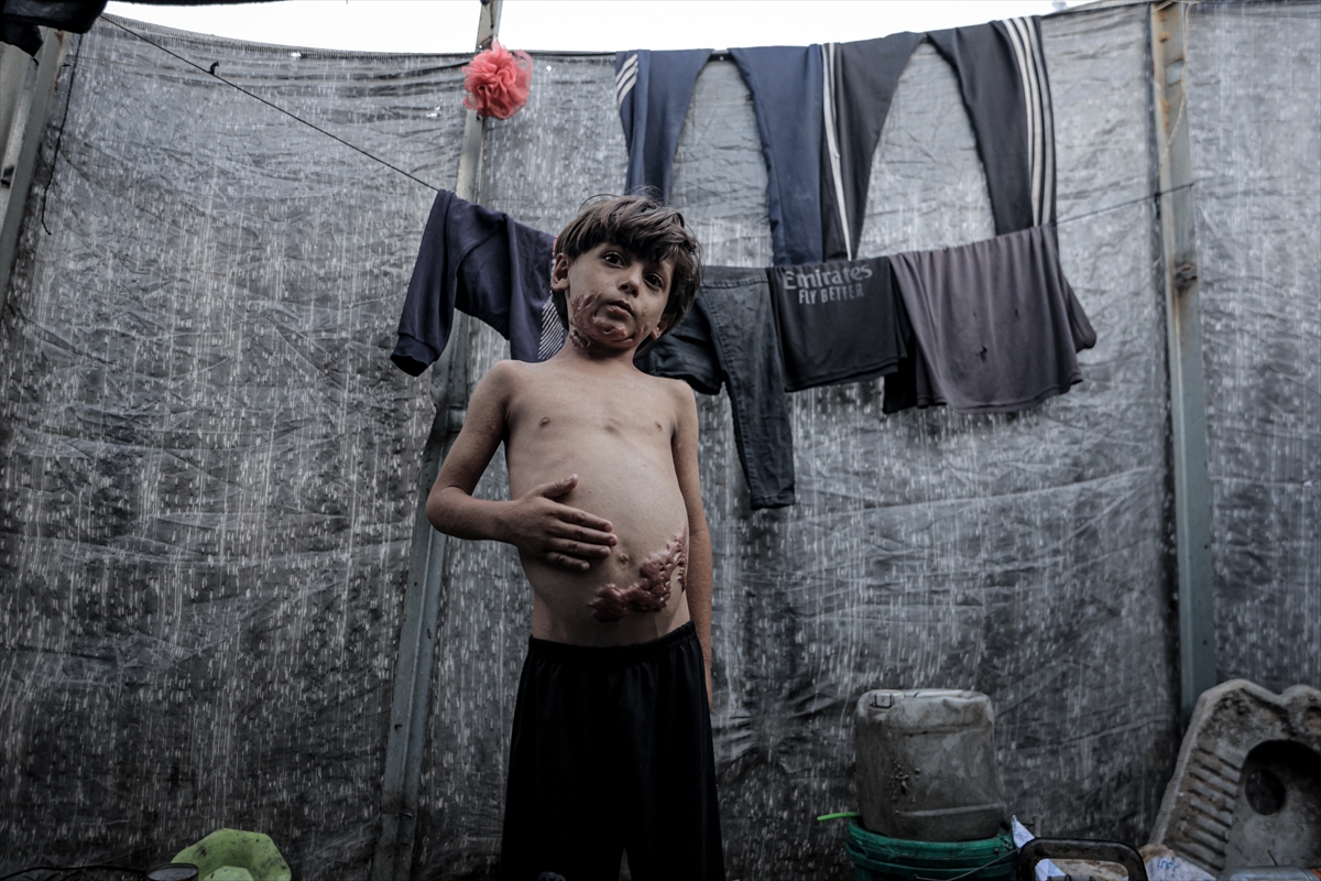 İsrail saldırısının hedefi olan çocuklardan biri: Muhammed