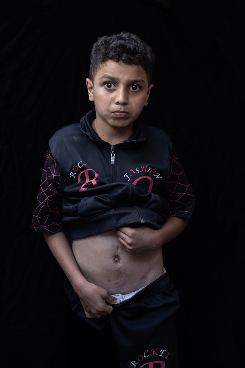 Gazze'de binlerce çocuk İsrail saldırılarında uzuvlarını kaybetti