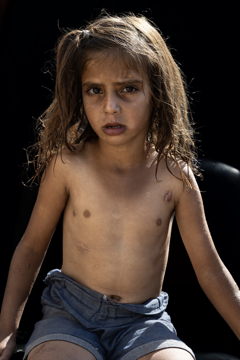 Gazze'de binlerce çocuk İsrail saldırılarında uzuvlarını kaybetti